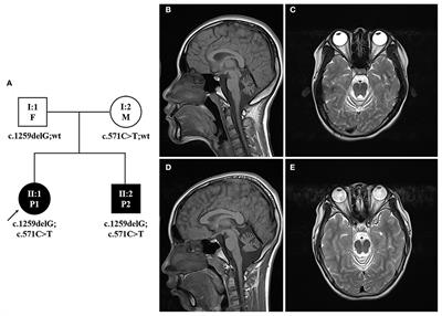 Indentification of novel MSTO1 compound heterozygous mutations in a Chinese family with recessive cerebellar atrophy and ataxia